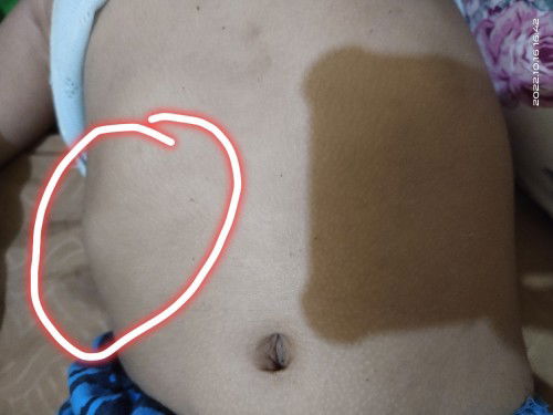 Tulang rusuk kanan menonjol