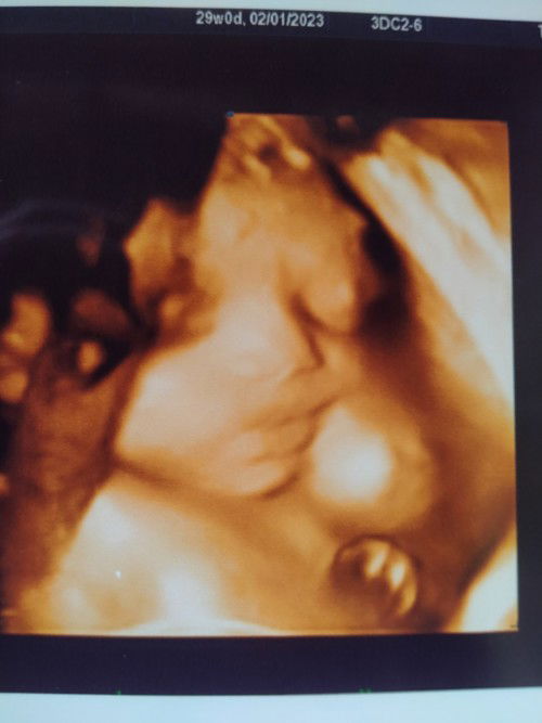 ตั้งครรภ์ 29 week