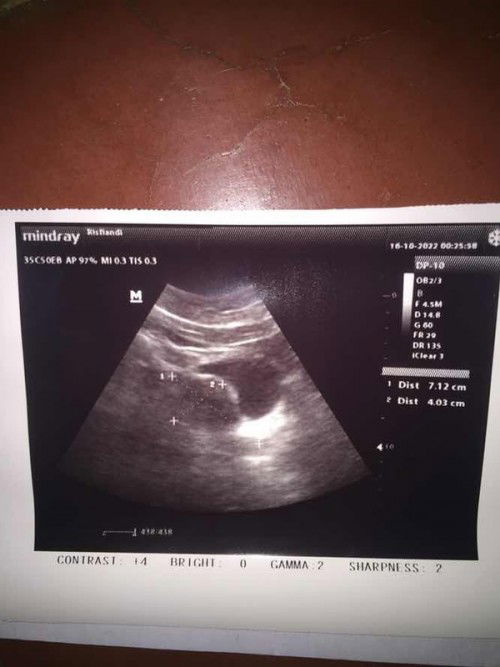 9w blum ada janin. Di sarankn untk usg transV