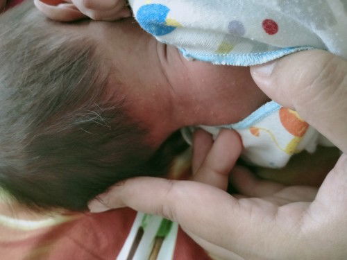 Bruntusan di leher dan wajah