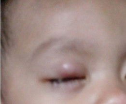 Mata Bintitan ( Timbilen )