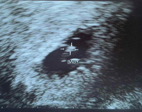 6weeks after IVF/FET scan show baby 5wk+