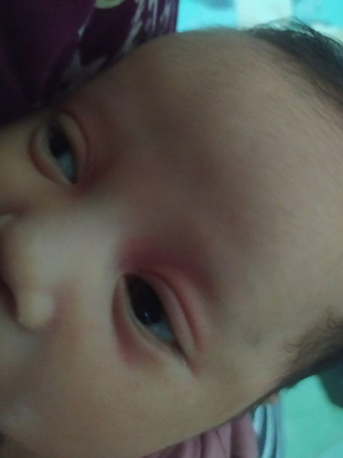 Mata merah pada bayi