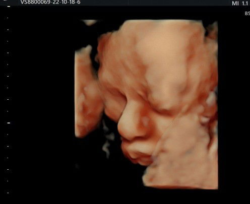 3D Ultrasound #Boy
