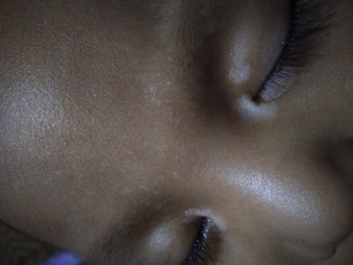 Bercak seperti sisik di daerah mata