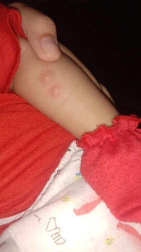 Bentol pada bayi
