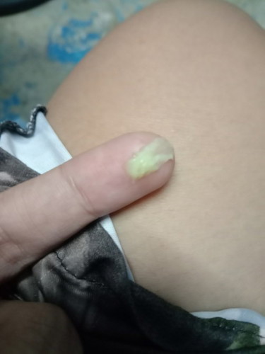 Hi mga sis ask lang Po sino ba sa nyo naka try nang ganitong discharge?? Normal lng ba ito sa preggy