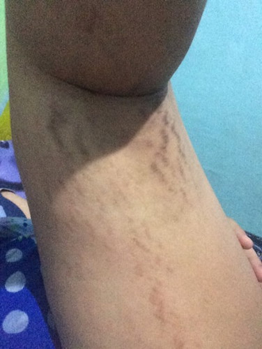 DARK STRETCHMARKS