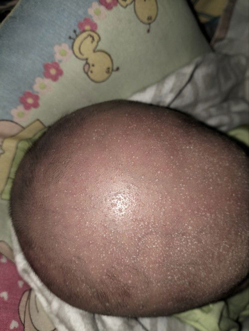 Kulit kepala bayi berair