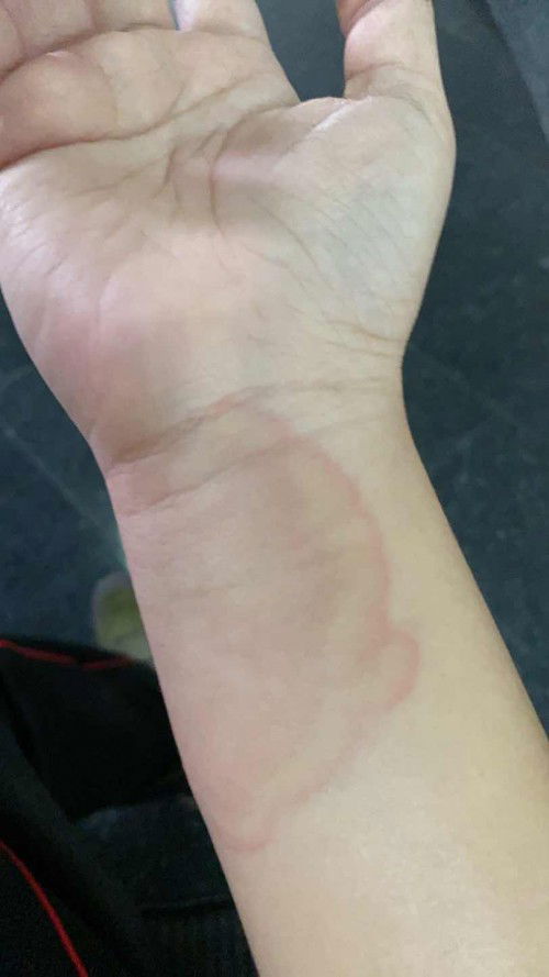 7 wk มีผื่นลมพิษขึ้นคะ