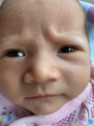 น้องมีปานเเบบนี้ตั้งเเต่คลอด เเต่สีไม่เข้ม 
ออกสีเขียวๆ  เหมือนรอยช้ำ  น้องจะหายไปเองไหมค่ะ  หรือต้องเลเซอร์ออก