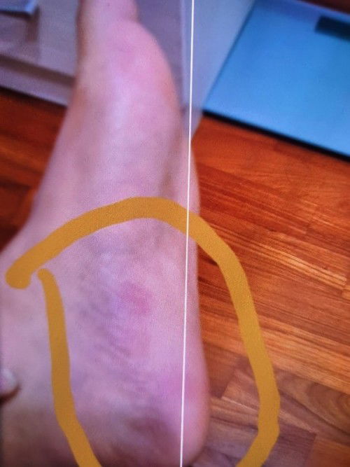 12th week, red spot in leg which is painful