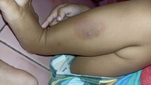Kulit anak tibatiba seperti melepuh