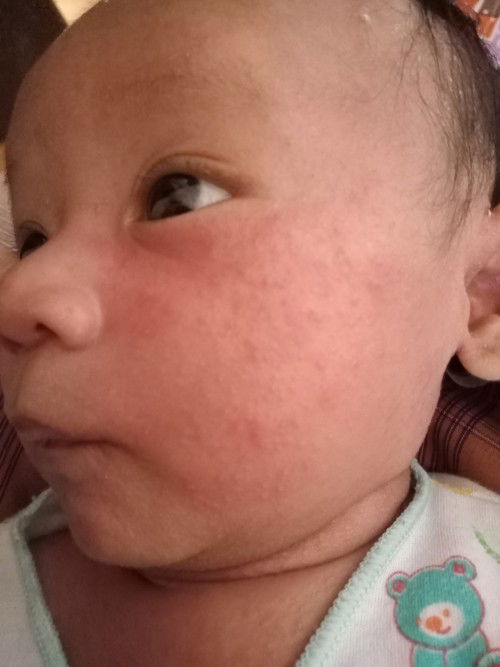 Seluruh tubuh baby merah beruntusan