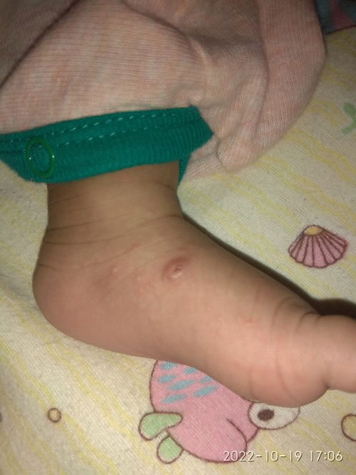 Benjolan dan bruntusan pada kulit bayi