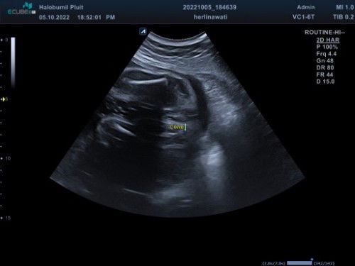 hasil usg cewek , tp meragukan