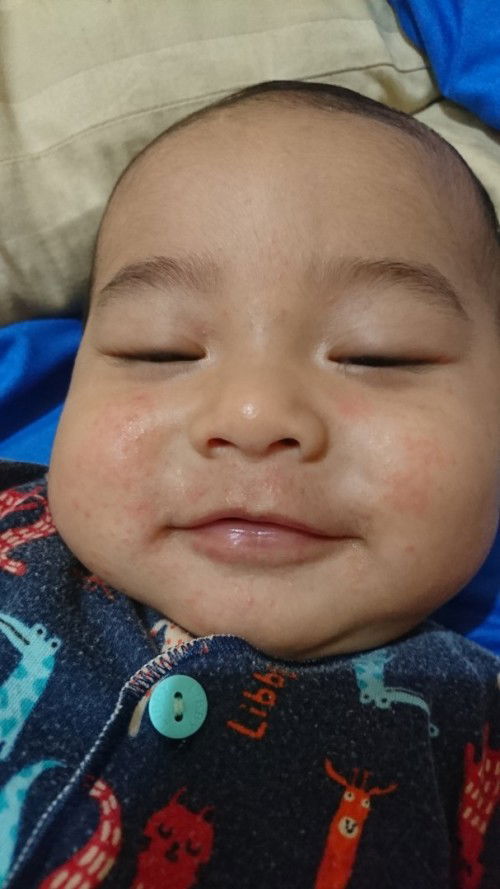 Muka bayi beruntusan