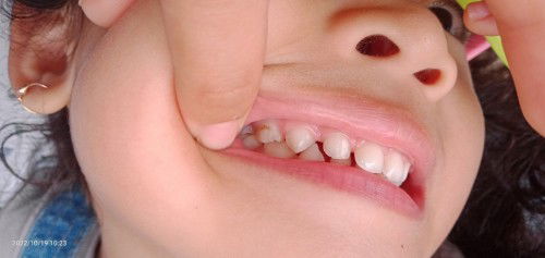 Gigi anak 3 tahun gigis. Apa sudah waktunya pakai pasta gigi berfluoride?