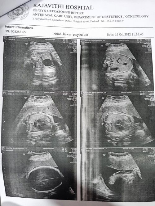 ตั้งครรภ์ได้ 33 วีค ไปอัลตราซาวน์ น้องไม่ยอมกลับหัว