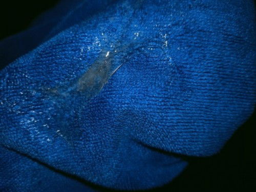 ผ่าคลอดครบ1ปี