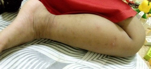 ตุ่มพองใสๆ   