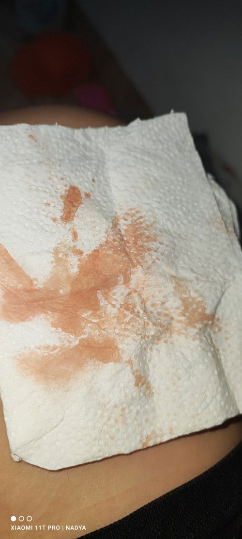 Ini termasuk Flek apa pendarahan ya bun?