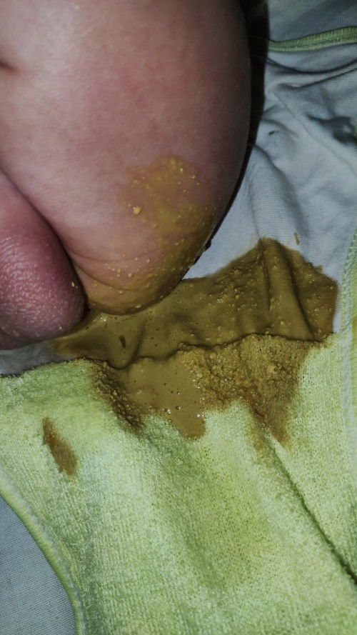 Diare pada bayi 1 bulan 26 hari