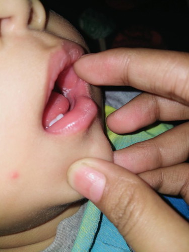 Putih2 kt dalam mulut bayi