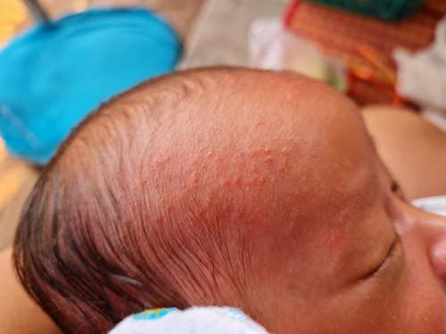 น้องมีผื่นขึ้นที่ศรีษะค่ะ