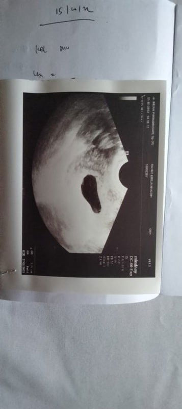 APAKAH ADA YANG PERNAH DIVONIS HAMIL KOSONG (BO), TETAPI MENDAPAT KEAJAIBAN DARI ALLAH ?