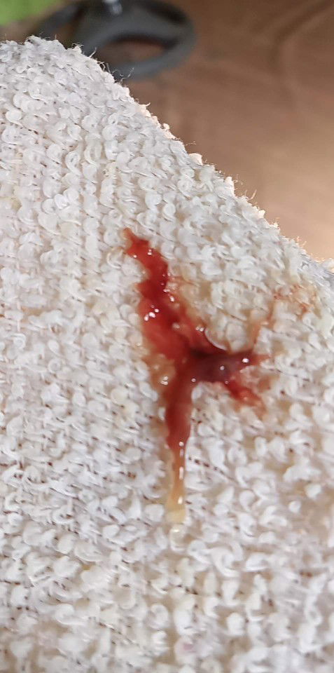 MUCUS PLUG WITH BLOOD