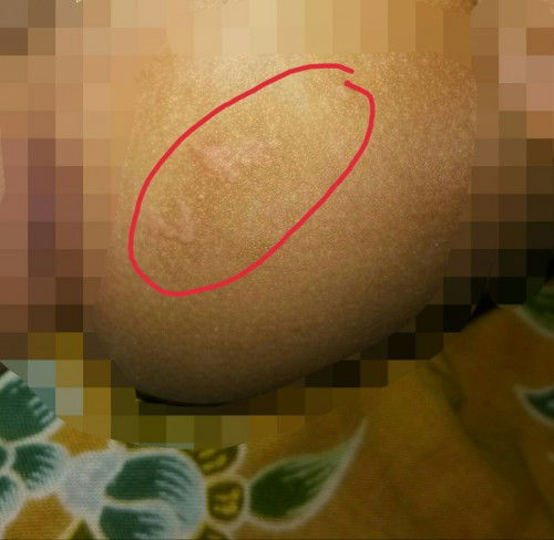 Ruam popok atau bukan?