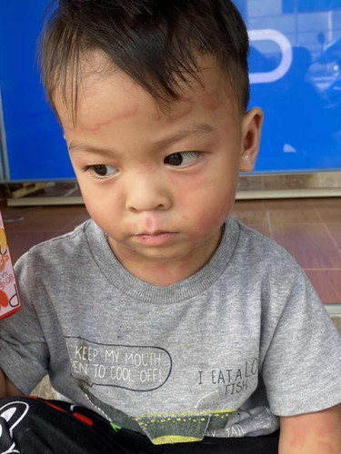 ขออนุญาตสอบถามค่ะ ลูกใครเคยมีปัญหาการแพ้แบบนี้บ้างไหมคะ น้องเป็นมา3วันแล้วค่ะ