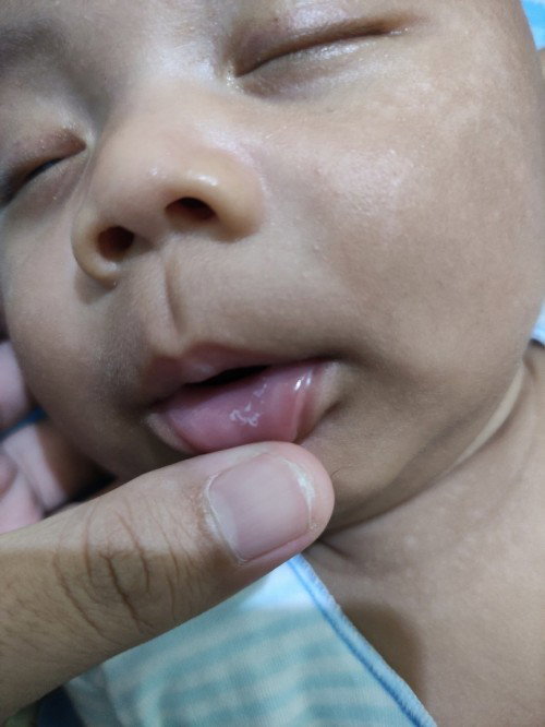 Jamur Bibir bayi