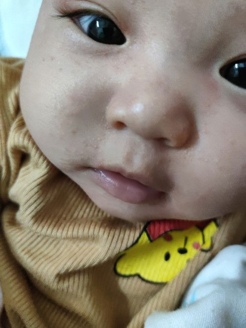 Mụn 4 tháng rưỡi