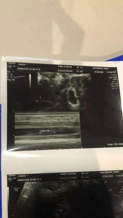 Hasil usg 5weeks, normal kan?