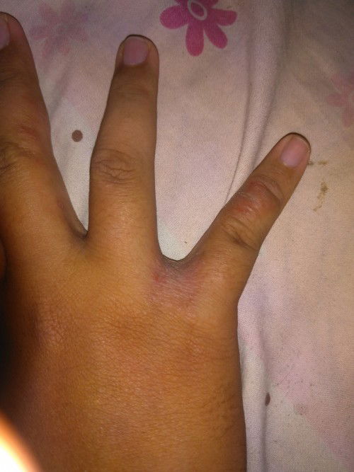 Ada yg pernah ngalamin seperti ini di kasih apa ya
Cuma di tangan sebelah kanan