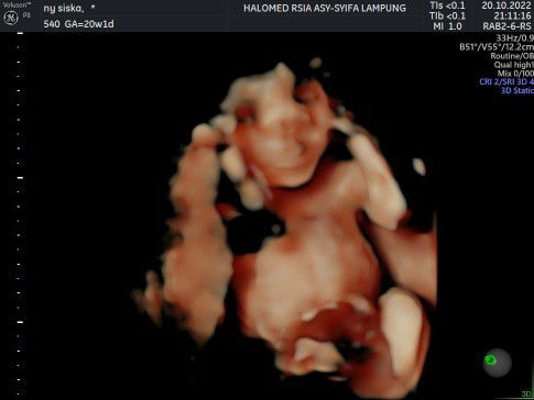 MasyaAllah TabarakAllah Usg 20w