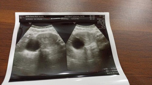 hasil tespeck  positif tapi belum terlihat kantung janin