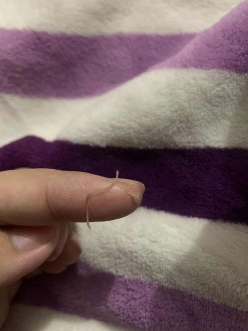 แม่ๆท่านไหนบอกได้บ้างว่ามันปกติไหม คลอดธรรมชาติ ไหมละลายหลุดออกจากช่องคลอด แต่แผลที่ตัดไหมยังอยู่ดี