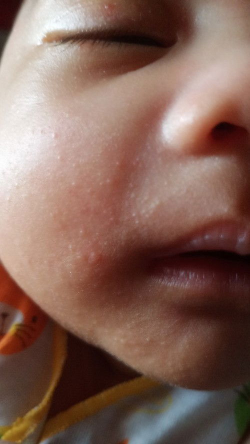 Wajah bayi kaya ada jerawat