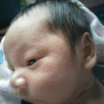ผื่นขึ้นหน้า