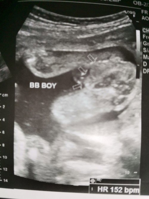 Gender (Girl o Boy)