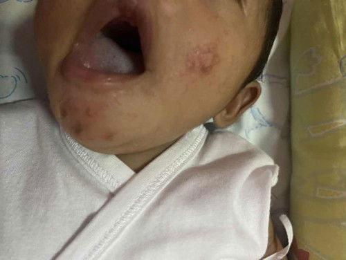 Rashes sa face ni baby
