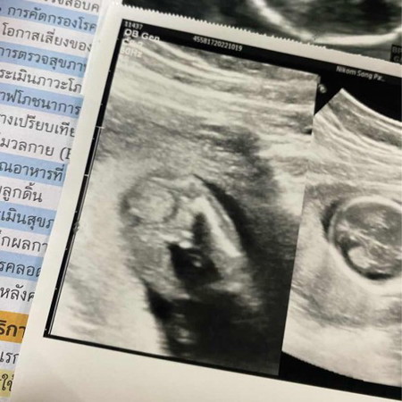 16w3d หมอบอกมีโอกาสสูงเป็นผู้ชาย