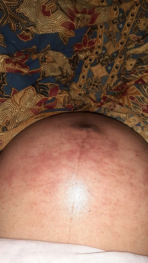 Ruam di perut bumil menjelang HPL