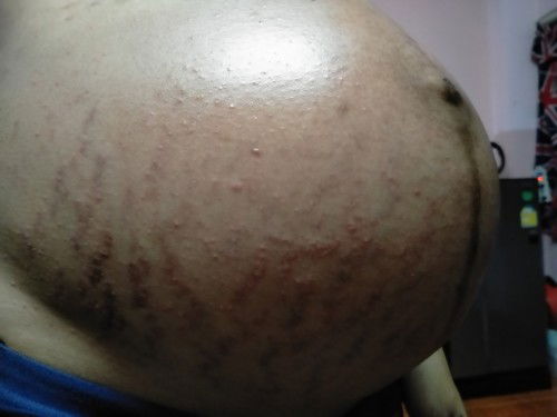 ผื่นขึ้นท้องแบบนี้ปกติไหมคะ