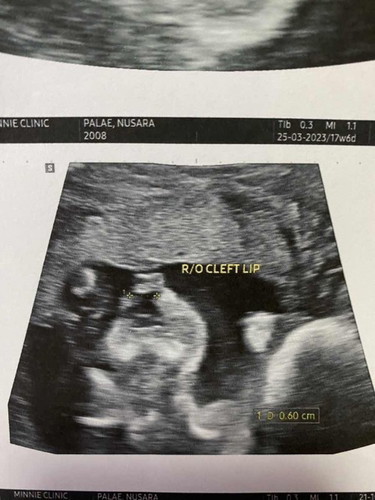 เด็กอาจจะเป็นปากแหว่ง