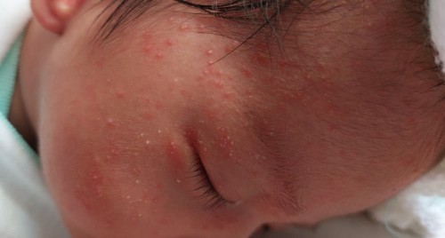 Mga moms ano po pdeng igamot sa rashes ni baby sa mukha at leeg? 19days pa lng po c baby ko