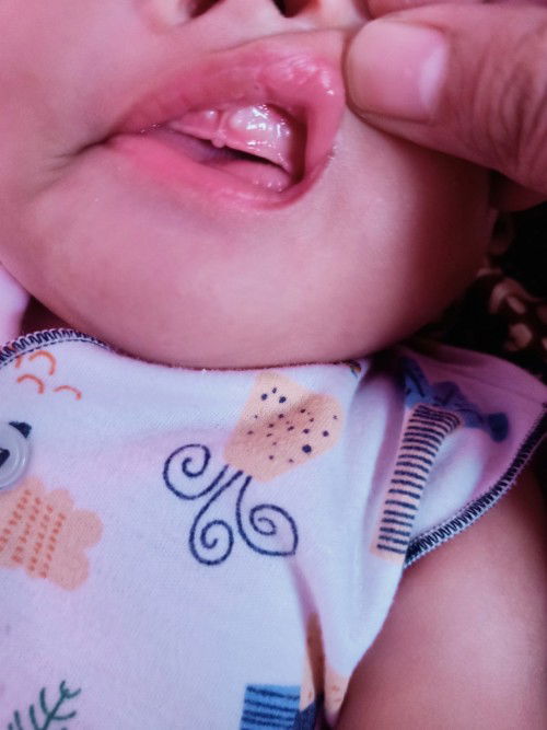 Muncul bintik putih keras di atas gusi pad bayi